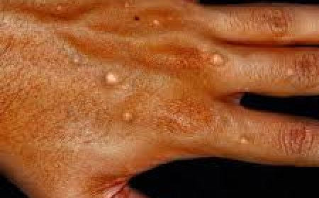 އެމްޕޮކްސް ފެތުރޭތީ އެޗްޕީއޭ އިން ފިޔަވަޅުތައް އަޅަން ފަށައިފި